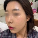 (주)바이더웨이 논현보람점 | 논현역 피부과 올리디아120 솔직후기 (마취크림/고통/엠보싱 붓기)