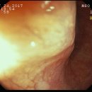 Rt. aortic arch with aberrant Lt. subclavian artery 증례 이미지