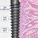 대구 임플란트 수술 후 관리 , 전문 의료진과 함께라면