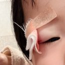 서초서울마더스성형외과의원 | 10개월 아기 얼굴 상처 봉합 수술_서초 마더스 성형외과의원