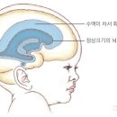 [ hydrocephalus ]수두증 이미지