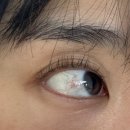 아이유안과의원 | [대구/아이온안과] 눈알 점제거, 결막모반 제거 찐후기