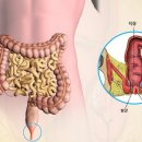 항문열상 이미지