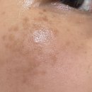 더 루미 | [더멜라기미잡티스팟크림 솔직후기] 더멜라루미샷스피큘스팟크림 2주 사용 변화!