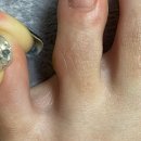 세븐레마의원 | 강남 세븐레마의원에서 ‘티눈 제거’ 후기(❌징그러운거 못보시면 들어오지 마세요❌)