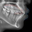 비우고채우는치과의원 | 치아벌어짐 치아교정] 광주 수완지구 교정 전문치과