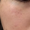 루나의원 | [루나의원 루비레이저 후기] 깨순이의 깨털기 (매끈매끈하다🎵매끈매끈한🎶)