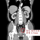 좌측 옆구리 통증으로 내원한 52세 남자환자 이미지