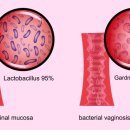 세균성 질염[bacterial vaginosis] 이미지