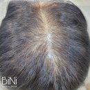가르마탈모 정수리탈모 견인성탈모 두피타투 두피문신 SMP 잘하는곳 후기 추천 라뷰티아카데미 [BiNi뷰티]