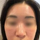 이건레이져 | 울트라클리어 청담피부과 나는솔로 30기 영수 레이저 효과 후기