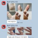 365정화약국 | 반복되는 건선, 알고 보니 ‘대사 스트레스’ 때문?– 5일 소식요법으로 피부 장벽 회복한 실제 사례