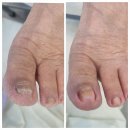 내성발톱과 발톱무좀 통합치료 ! 서울늘봄메디칼의원에서 꾸준히 진행한 후기