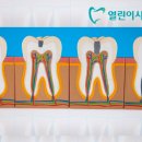 열린이사랑치과의원 | 포항 신경치료 잘하는 치과를 고르는 기준이 있나요?