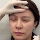 중국 필러성형(왕징식) 유행이라길래 중국 성형영상 몇개봣는데 애교살 이런식으로 만드나봄 이미지