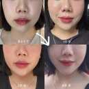 강남역 | 쿨소닉 리프팅, 통증 없는 중안부 탄력 효과 강남역피부과 후기