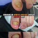 산본 발톱무좀케어, 발톱무좀으로 발톱까지 뽑았었던 무좀발톱 케어하기 이미지