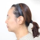 연세브이의원 | 목거상, 얼굴을 아무리 당겨도 목주름이 해결되지 않는 이유가 있습니다