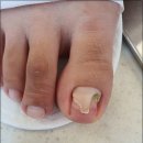 라이프업 | 광주 농성동 발톱무좀 관리 꾸준히 받은 진짜 후기 뷰티업라이프 페디네일