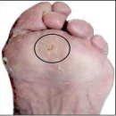 3-3. 발의 부위별 후천적 상해의 종류와 예방법 이미지