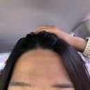 늘샤인 의원 | 좁은 이마 레이저 제모 후기 1회 ‘야탑 늘샤인의원’ (내돈내산)