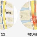 손 저리고 뒷목 뻐근하다면··· 인대가 굳는 ‘이 질환’ 의심 이미지