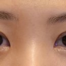 뽑아가세용 | 쌍수 절개 재수술 한달 후기✨두줄따기+눈매교정 후 붓기 변화 과정 후기
