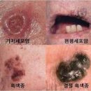 악성 흑색종 (Malignant melanoma) 이미지