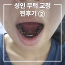 미소드림약국 | 성인무턱교정 후기 ②┃무턱교정 치료 과정 상세 후기┃장치 부착 5일차┃준비물, 꿀팁