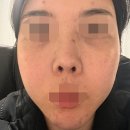 성가약국 | 약국 좁쌀여드름 연고 주의사항 정리