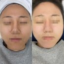 유성슈퍼 | [이용후기] 유성 여드름관리 추천 슈퍼큘 “프리시엘 스킨”