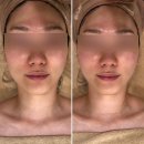 하남윤곽관리 명윤곽 명근막관리 솔직후기