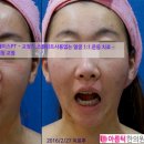 안면비대칭후기 실치료사례 보기 :아름턱한의원