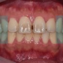 뉴마스터치과기공소 | 미니쉬 가격 얼마? 확실하게 말씀드릴게요