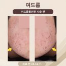 영등포 여드름 피부과 치료 후기_20대 남성_피부과 전문의