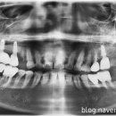 엔도코어 이미지