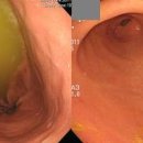 담즙 역류성 위염 원인 증상 치료 이미지