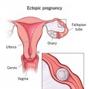 자궁 외 임신[ectopic pregnancy] 이미지