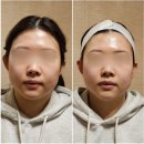 아미가 피부체형 | [송파구/잠실피부관리] 잠실입체윤곽, 얼굴축소 고민해결ㅣ‘아미가에스테틱’ 신부이중턱 관리 후기