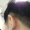 연세킹의원 | 귀피지낭종 귓볼피지낭종 치료 수술비용 피지낭종제거비용 치료후기 인천청라외과 연세유쾌항외과