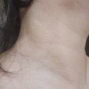 잡엑스 | 비렌느 스팟 엑스 비립종과 쥐젖 편평사마귀 제거 내돈내산 후기