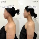 무니크뷰티(Moonique) | [부천 상동역] 무니크 / 에어바디 융복합에너지 테라피, 1회 관리로 정리되는 승모근, 후면 관리 후기