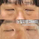 멍반장 | 강남 논현피부과 눈밑지방재배치레이저 피곤해보이는 신랑 수술없이 루엘프팅 가격 후기