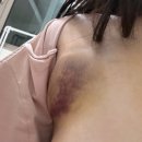 빡빡아 머리깍자 | 내돈내산 담소유병원 부유방제거 퇴원 후-일주일간 후기 + 재수술 한 이유