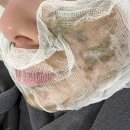 희망약초 | 송파여드름한의원 여드름 흉터 치료, 미세약초침 내돈내산 후기