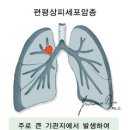 폐암 lung cancer 이미지