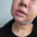 외곡 | 안면윤곽 3종+앞턱전진+귀족수술 내돈내산 일주일차 붓기 후기 [1-7일]