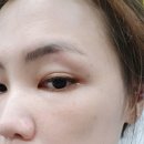 충용의원 | 노원 중계의원 예약 후 잡티 뽑고 왔어요! 혐짤주의