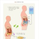 투석치료비(급여)(1년50%) 특별약관 (투석치료(급여)의 정의) 이미지