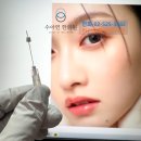 수아연한의원 | 눈꺼풀 리프팅 눈처짐 실리프팅 후기 자연스런 시술 원하신다면